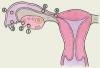 Внематочная беременность: диагностика и лечение